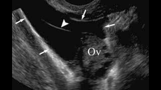 Gynaecology ultrasound cases15 case in 15 minutes sonopediauterine and adenaxal pathology [upl. by Alenson969]