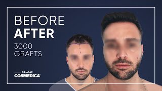 Transformation After Hair Transplant in Turkey at Dr Acars Clinic [upl. by Oster432]