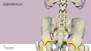 Diskbråck Spine Center Göteborg [upl. by Mignon]