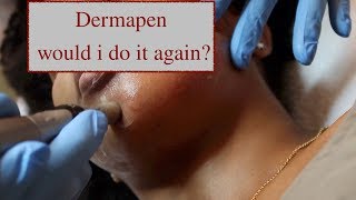 Dermapen Update  Clearing Up Dark SpotsHyperpigmentation [upl. by Nwahsram118]