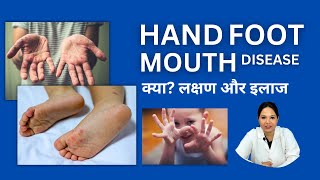 Hand Foot and Mouth Disease in Hindi [upl. by Hermosa383]