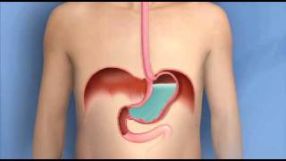 Heartburn Acid Reflux GERDMayo Clinic [upl. by Ynohtnad]