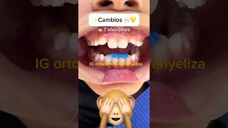 Bite block orthodontictips ортодонтия kieferorthopädie विषमदंत ortodonzia orthodontie [upl. by Simonne]