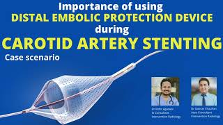 Importance of using distal embolic protection device during carotid artery stenting [upl. by Nord]