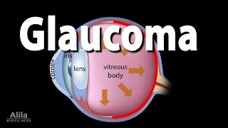 Development of Glaucoma Animation Open Angle vs Angle Closure Glaucoma [upl. by Egroj]