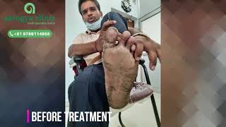 PALMAR PSORIASIS COMPLETE CURE AT AAROGYA CLINIC VELLORE [upl. by Nwahsal]