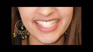 Invisalign for Adults A Better Way to a Straighter Smile [upl. by Ardnuhsal]