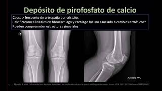 Radiología en 5 minutos Depósito de pirofosfato de calcio [upl. by Odidnac]