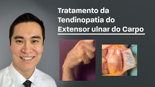 Tratamento da Tendinopatia do Extensor Ulnar do Carpo [upl. by Eenahpets863]