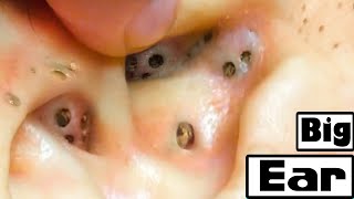 Deep Removal Of Blackheads In The Ear [upl. by Madel697]