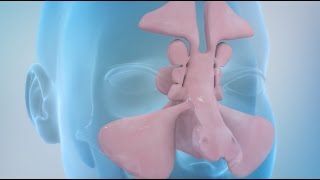 Sinusitis and Sinus Surgery Explained Balloon Sinuplasty and Endoscopic Sinus Surgery [upl. by Llerud]