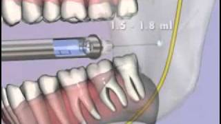 Medical Videos Malamed s Local Anesthesia 10 Mandibular Injections flv [upl. by Tessler]