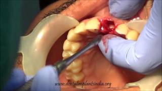 Extraction of failed root canal treated tooth replacement with immediate implant placement [upl. by Ziladnerb653]