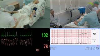 Реанимация роженицы при помощи манекена Gaumard [upl. by Jemma]