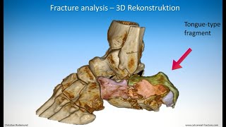 Technique of minimalinvasive treatment on a calcaneal fracture  Tonguetype [upl. by Charpentier]