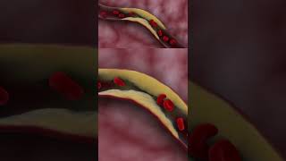 Thrombotic ischemic stroke doctor science biology film4health hospital [upl. by Yellah]