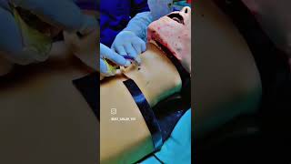 Tracheostomy procedure 🏥🩺🎉 chatalternative textonly [upl. by Omlesna]