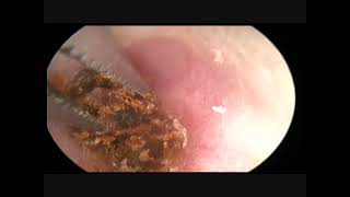 Gros bouchon de cérumen earwax removal JB DANVIN 1 [upl. by Llebana]