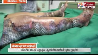 Brazil uses fish skin to treat skin scars   Polimer News  FishSkinTreatment Brazil [upl. by Burnsed]