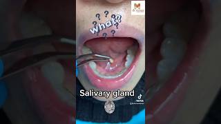 Salivary glands stone [upl. by Egroej]