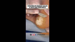 SCRAPING OF MASSIVE CALLUS amp DEAD SKIN FROM HEELS 2023 BY MISS FOOT FIXER [upl. by Carhart]