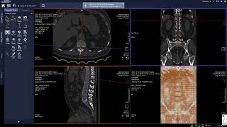 How to automatically spine labelingin ctscan ct somatom go nowctscanner radiology cttech [upl. by Decamp372]