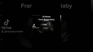 Frank Breech Baby on Ultrasound at 26 Weeks Pregnant [upl. by Doowron]