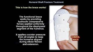 Humeral Shaft Fracture Treatment  Everything You Need To Know  Dr Nabil Ebraheim [upl. by Soracco]