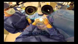 Endothelial Keratoplasty Part 4 Preview [upl. by Madigan]