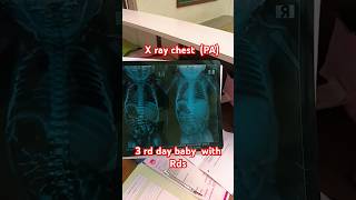 X ray chest 3 rd day babyviralvideo cutebaby babyshorts shortvideo shortsfeedtrending diwali [upl. by Ledba]