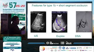 BuddChiari Syndrome Imaging Features and Radiological Interventions [upl. by Ielarol937]