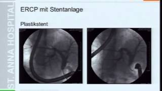 Palliative endoskopische Therapie des Pankreaskarzinoms Teil I [upl. by Morganstein]