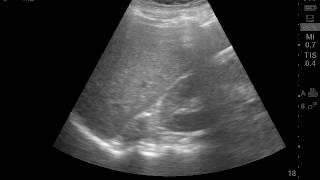 Right adrenal gland tumor [upl. by Ruthi808]