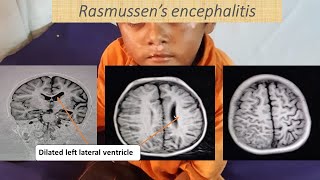 A case of Rasmussen’s Encephalitis  Pediatrics [upl. by Ennaxor497]