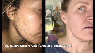 113 HOURS of electrolysis permanent facial hair removal before amp now PCOShirsutismbearded women [upl. by Haret873]