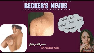 beckers nevus in hindi [upl. by Retrop]