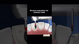 Zirconia restoration for anterior teethasmrvideo dentistsatisfyingandrelaxingdentalmasteryhubyt [upl. by Idihc]