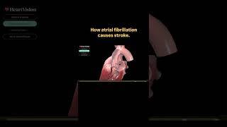 Atrial fibrillationStrokeanatomy nursing medicalnursing cardiovascular [upl. by Liag]