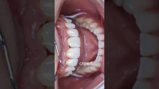 Veneers vs Crowns Which is BEST for Your Smile [upl. by Eirrok]