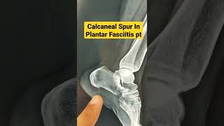 Calcaneal Spur In Plantar Fasciitis ptDr Sai Chandra [upl. by Jillayne309]