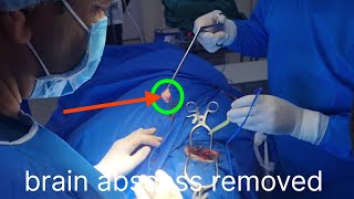 anesthesia for brain abscess induction intubation surgeryrecovery anesthesiology [upl. by Eidnam]