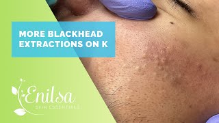 More Blackhead Extractions with K [upl. by Enilec439]