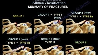 Clavicle Fractures Classification  Everything You Need To Know  Dr Nabil Ebraheim [upl. by Haelam]