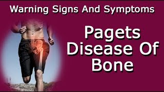 Warning Signs And Symptoms Of Pagets Disease Of Bone [upl. by Anyer]