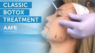 Full Face Botox Treatment  AAFE [upl. by Kramlich573]