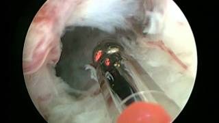 GreenLight Enucleation of the Prostate GreenLEP by Dr Fernando Gomez Sancha [upl. by Dygert310]