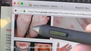 What Is Hand Foot Mouth Disease And How To Help Your Child [upl. by Eednahs601]