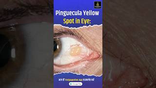 Pinguecula Yellow Spot in Eye Pinguecula eye testpaperlive [upl. by Jud]