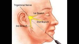 Trigeminal Neuralgia [upl. by Meredi]