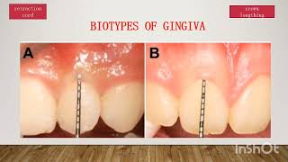 diagnosis fixed prothodonticstips and tricksbiotypes of gingiva [upl. by Aromas477]